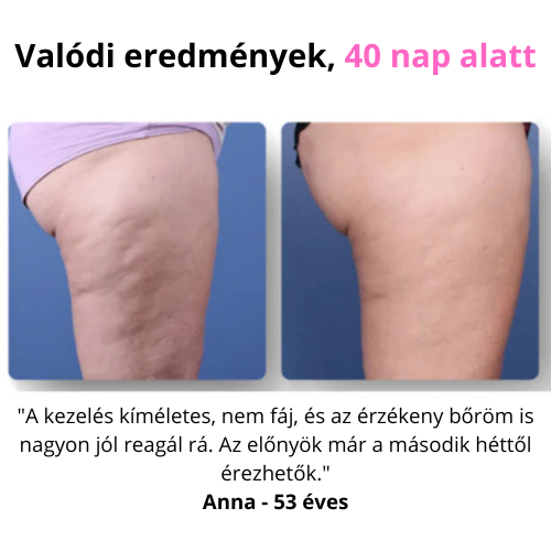 CelluStop - Anticellulit Masszírozó